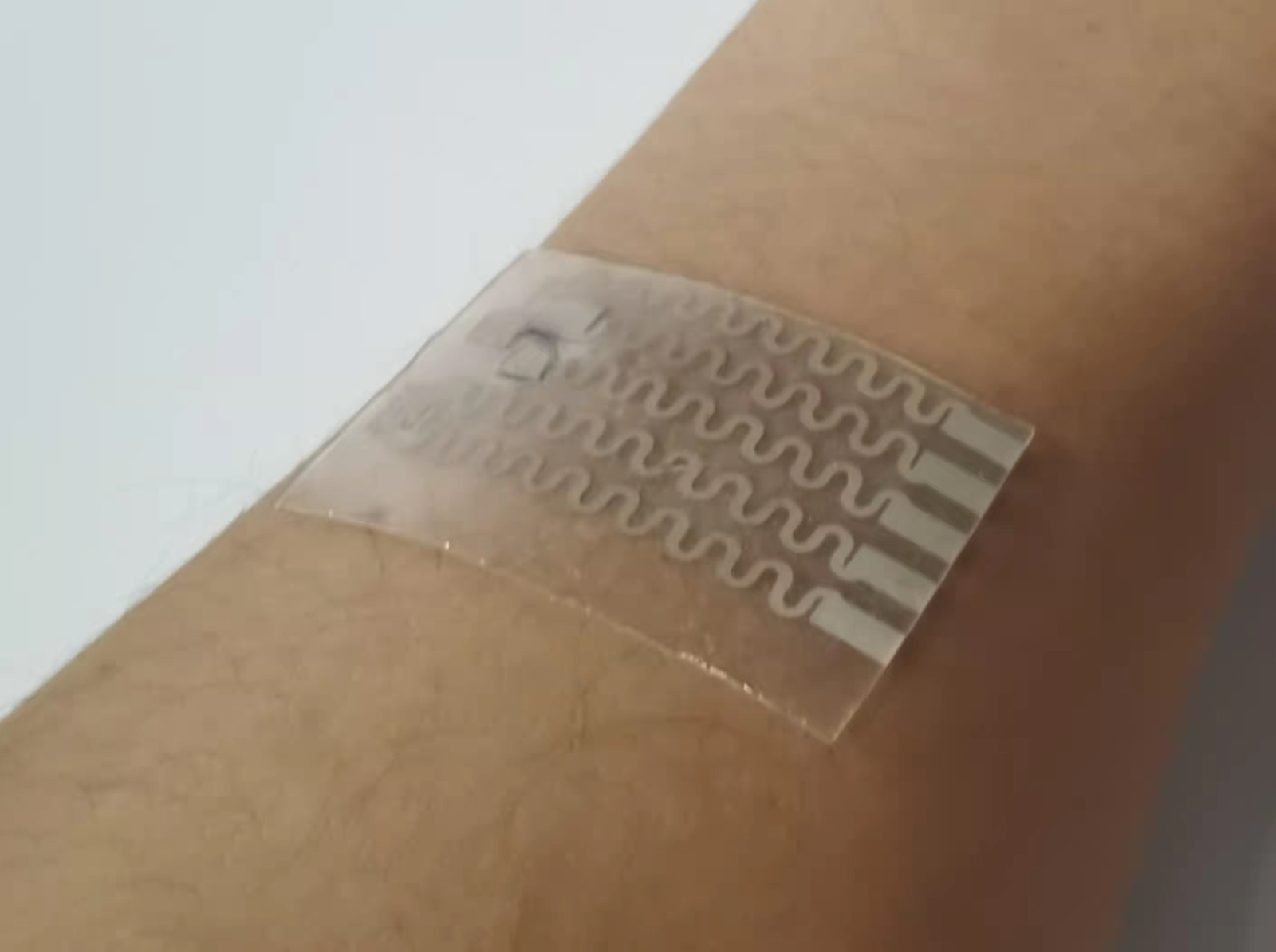 Smart Wound Dressing Technion