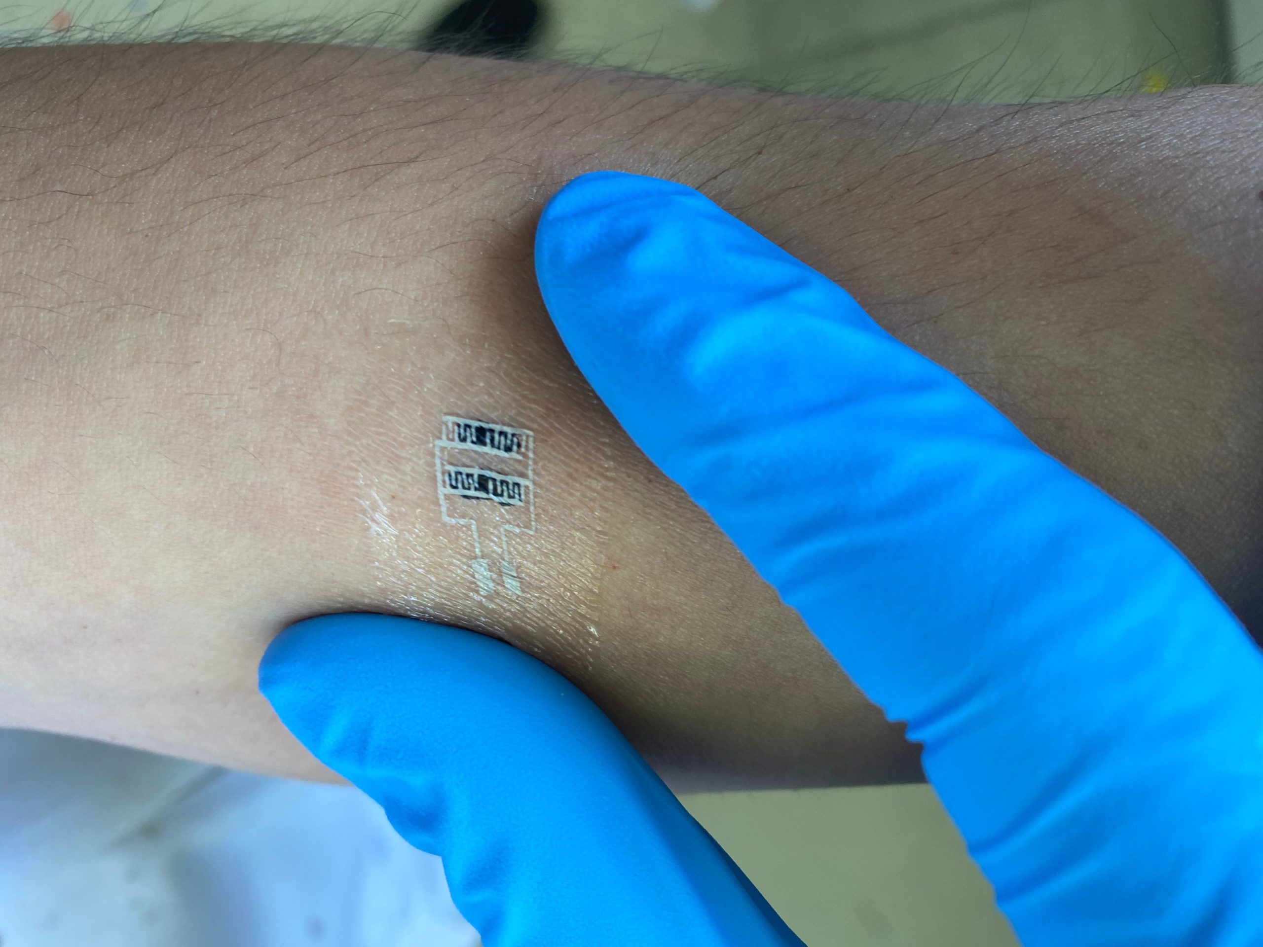 Technion Scientists Develop a Tuberculosis-Diagnosing Sticker Patch