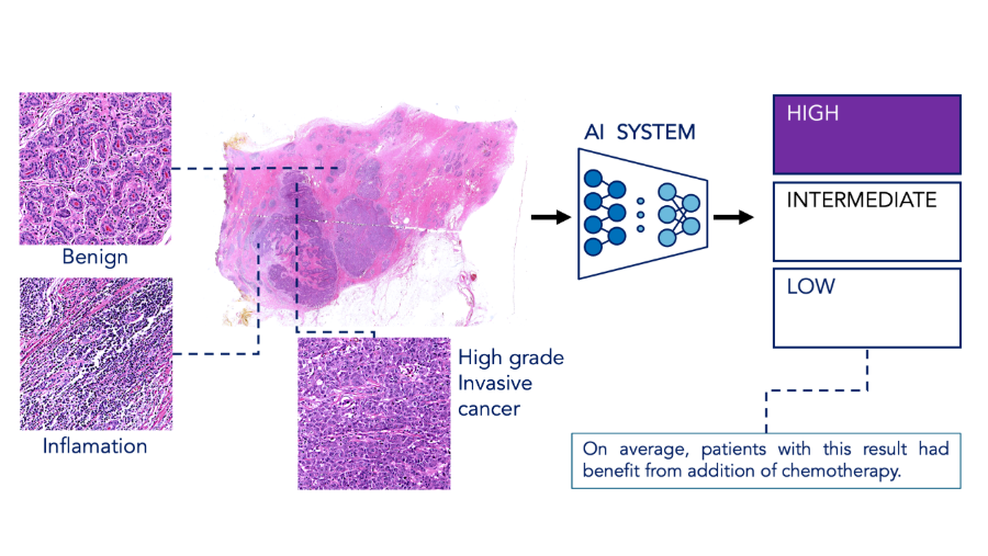 Technion researchers developed an AI model that predicts breast cancer recurrence and chemotherapy benefit using standard pathology slides—faster and more accessible than genomic tests.